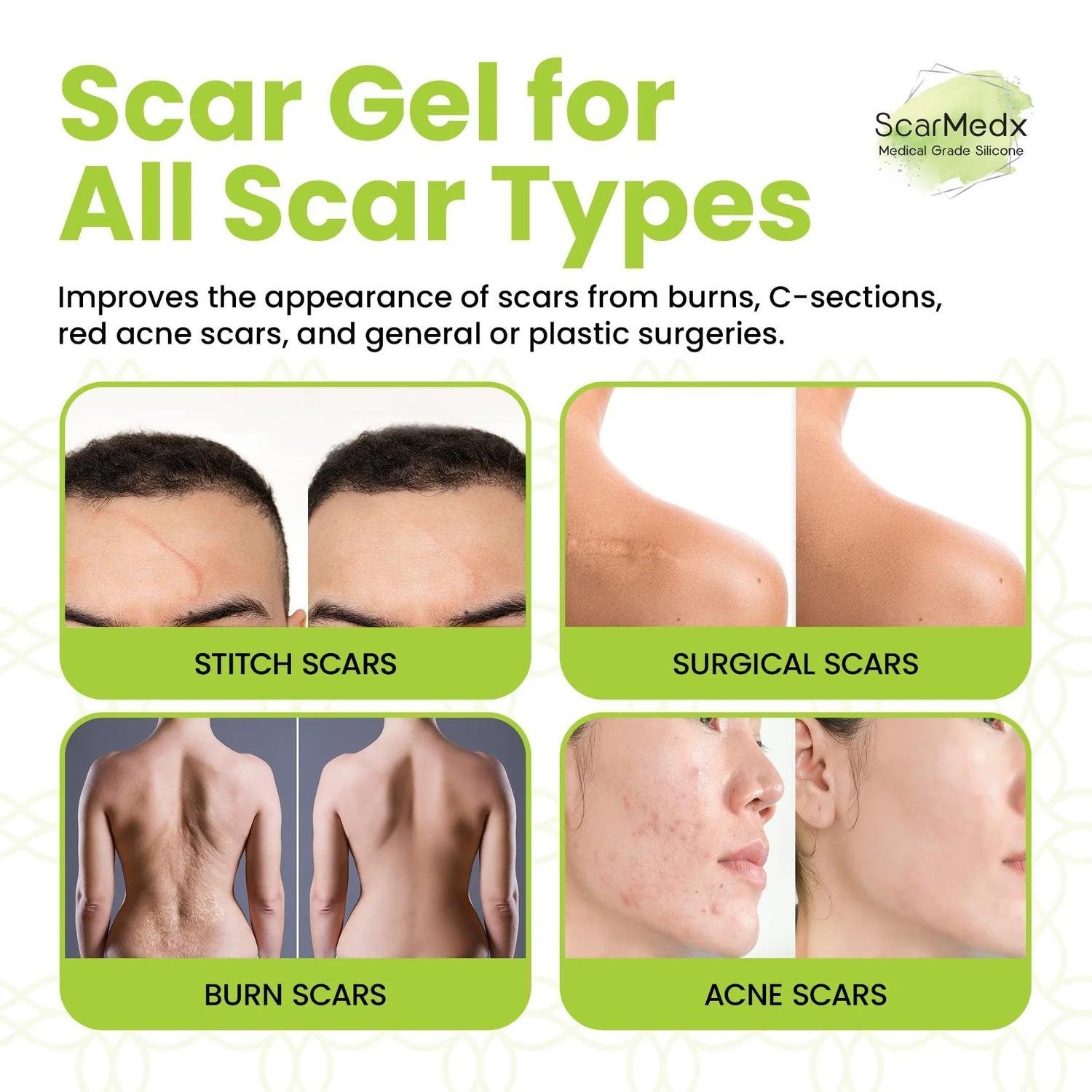 Zen Nutrients ScarMedx Advanced Scar Gel, Medical Grade Silicone Gel thumbnail 4