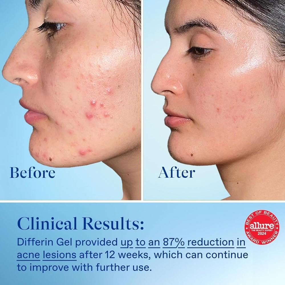 Differin Gel Adapalene 0.1% - Acne Treatment thumbnail 3